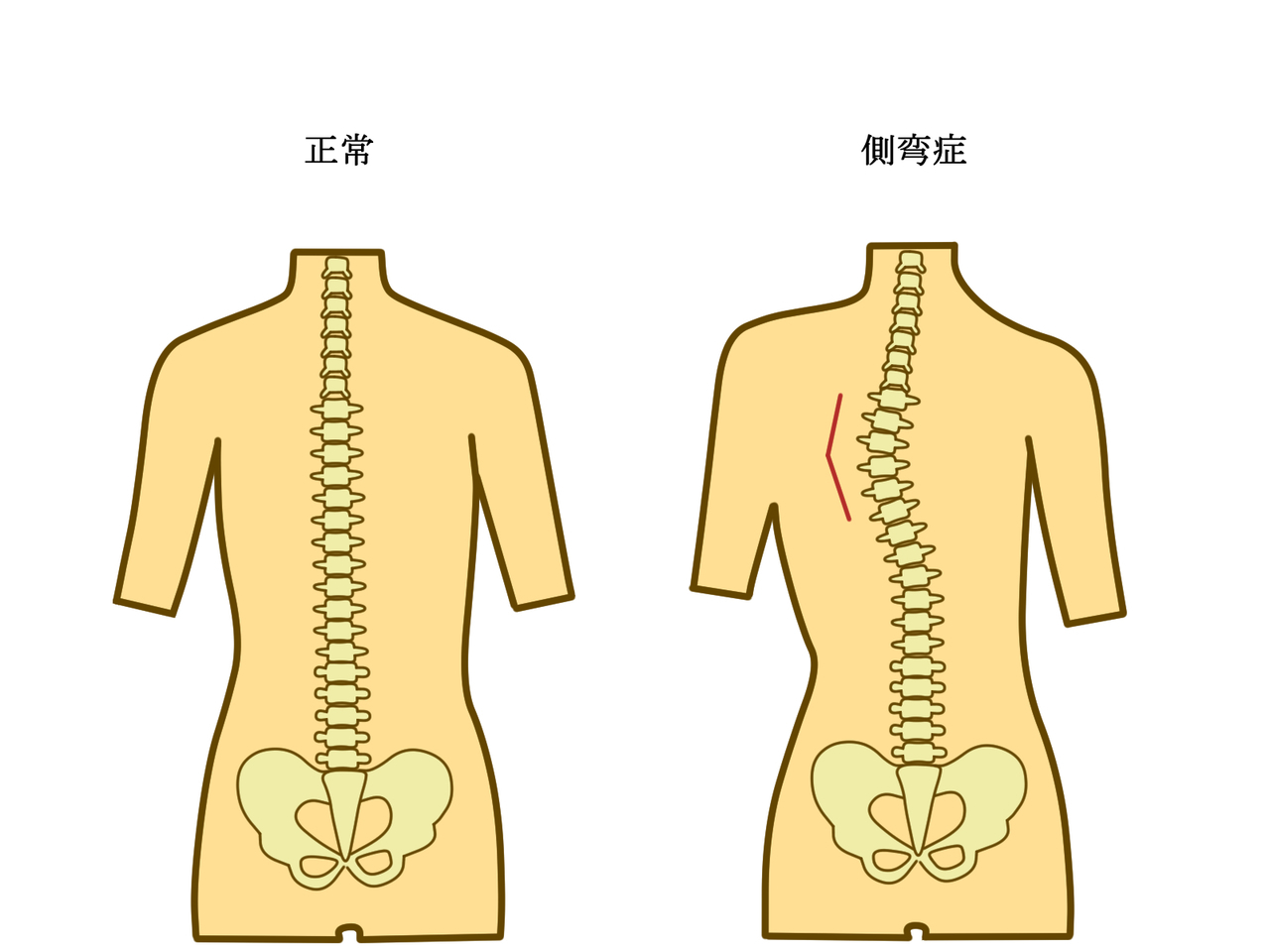 正常な背骨と側弯症の背骨のイラスト