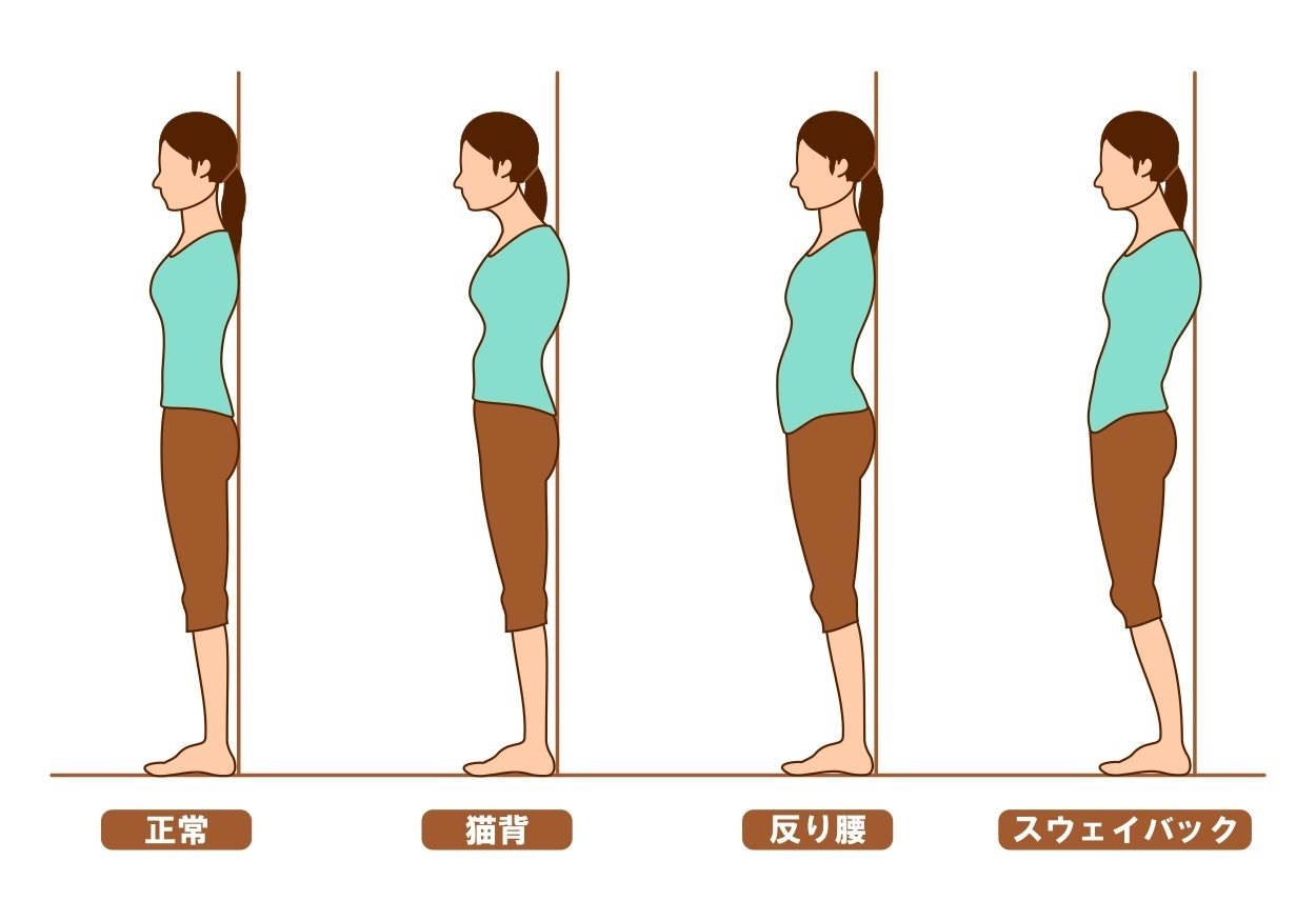 横から見た正常な姿勢と反り腰の姿勢のイラスト
