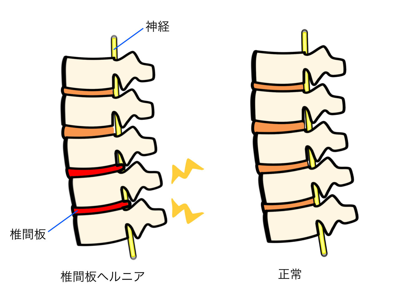 腰部椎間板ヘルニアの説明画像