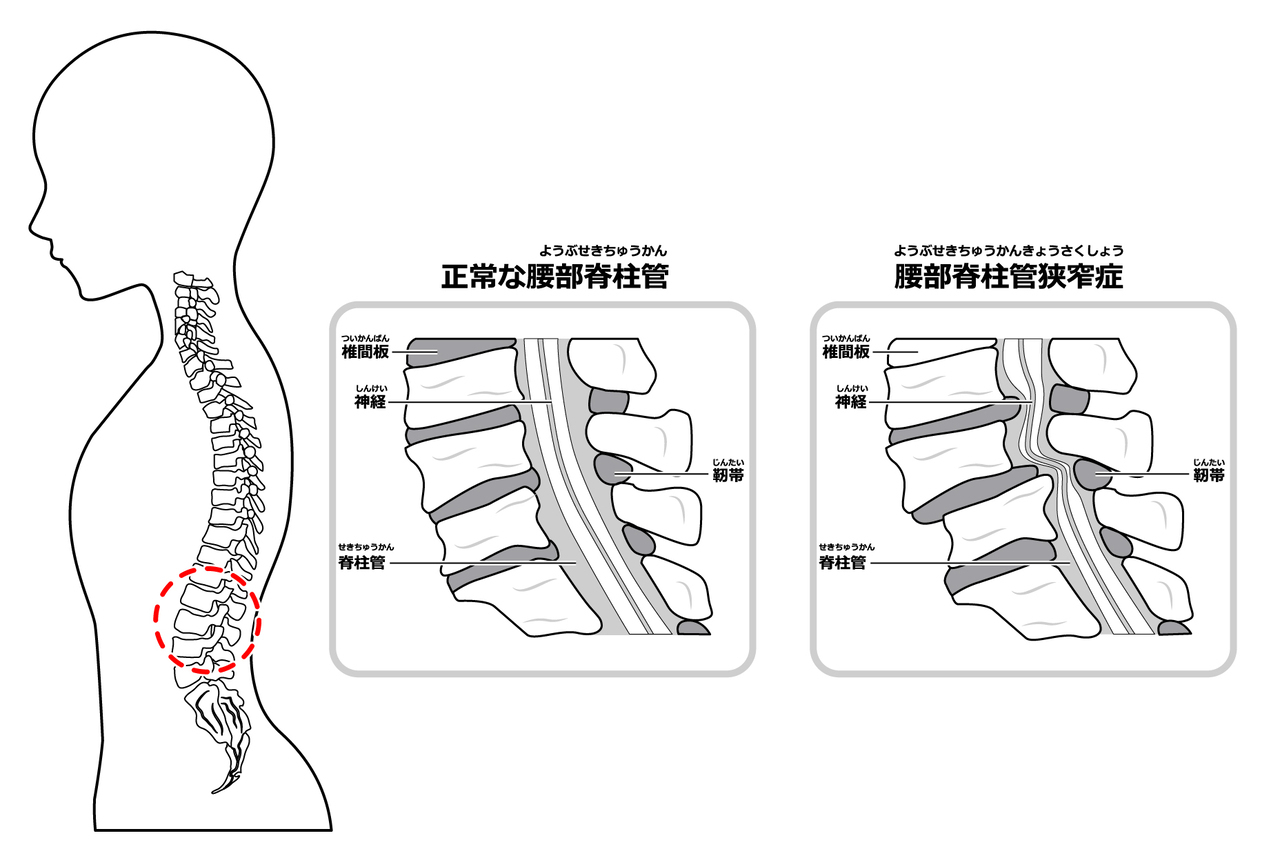 正常な腰部脊柱管狭窄症と腰部脊柱管狭窄症になった背骨のイラスト