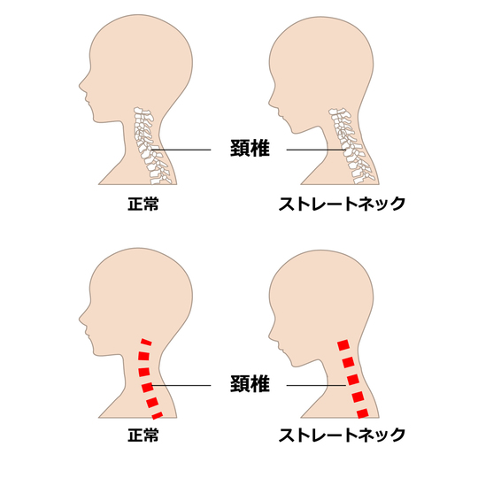 横から見た正常な首とストレートネックの画像