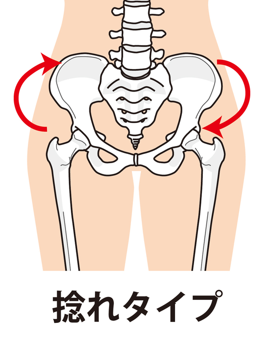 捻じれた骨盤のイラスト