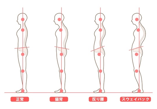 悪い箇所に印をつけた、横から見た正常な姿勢と反り腰の姿勢のイラスト