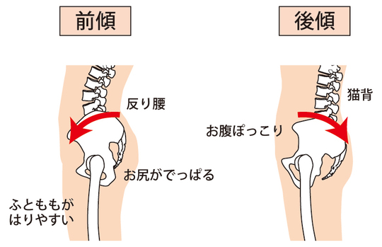 前傾した骨盤のイラスト