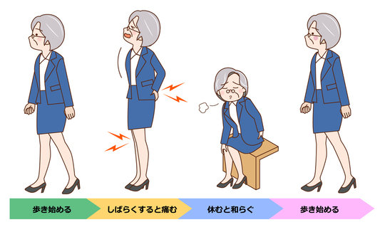 間欠性跛行のイラスト