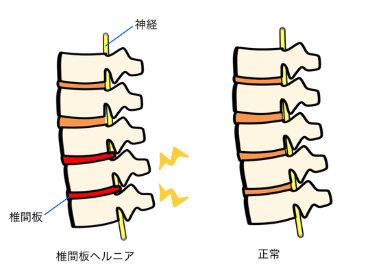 腰部椎間板ヘルニアの説明画像