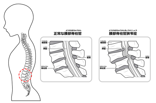 正常な腰部脊柱管狭窄症と腰部脊柱管狭窄症になった背骨のイラスト